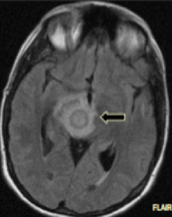 Brain abscess. Treat by surgical drainage or excision, or antibiotics if the abscess is small. 

Abscesses are polymicrobial infections that are encapsulated by a fibrous cap. It's generally filled with pus.
