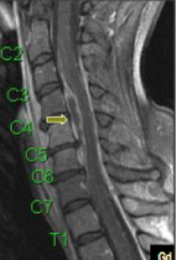 Spinal epidural abscess. 

Symptoms: triad of fever, spinal painand neurologic deficits may be present. 

Pathophysiology: probably hematogenous, or direct extension from contiguous infection, or direct inoculation (knife, spinal surgery, etc.)