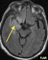Clinical presentations: fever, seizures, focal neurologic signs, impaired consciousness

Neuroimaging: temporal, limbic, and orbitofrontal lobes
bilateral and often asymmetric. 

NOTE: Herpes encephalitis is the most commonly fatal encephalitis.