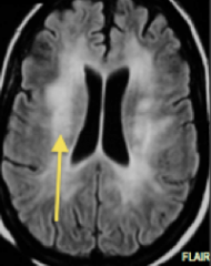 What is affected more here: grey matter or white matter?

Clue: this is viral encephalitis. What virus might this be?