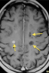 This is MS! 

Note the multifocal lesions. There are white spots (more active demyelination), and the black holes (old attacks that have already undergone liquefactive necrosis)

Note: metastases to the brain can also be multifocal - but they will sho