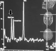 Is this a normal or abnormal MR-spectroscopy? How do you know?