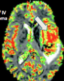 You have increased relative blood volume supplying that area. Can be seen on MR-Perfusion Weighted Imaging.