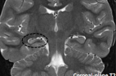 Temporal lobe, more specifically atrophy and gliosis in the HIPPOCAMPUS.