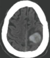 What is the likely cause of what is shown in the CT above?