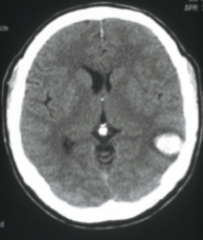 What is the likely cause of what is shown in the CT above?