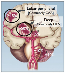Location in the brain:
- Two general categories in terms of pathophysiology:
-- Lobar (towards the periphery, typically linked to cerebral amyloid angiopathy [CAA])
-- Deep (in the deep white matter of the cerebrum, typically linked to hypertension)

