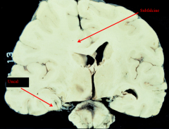 1) occurs when swelling pushes brain parenchyma UNDERNEATH FALX CEREBRI at the midline of the cerebrum 

2) anterior cerebral artery; infarction of medial frontal cortex