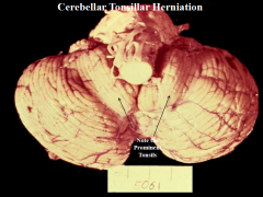 1) Cerebellar Tonsillar Herniation - severely elevated intracranial pressure leads to pushing of brain downward into foramen magnum → impact the medulla → compress respiratory centers → DEATH

2) FALSE FALSE FALSE 
Tonsillar herniations are NEUROSURGIC