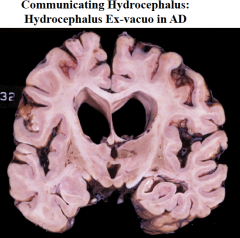 1) Communicating - impaired resorption (or excessive production) of CSF  

2) Alzheimer's Disease