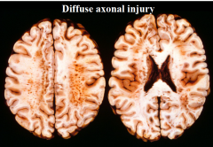 Occurs as consequence of disease or trauma: white matter tracts are sheared or cut 

Usually see in motor accidents → causes coma immediately, which is a very bad sign (may never regain consciousness and are usually in vegetative state) 

2) FALSE FAL