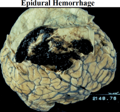 1) middle meningeal artery (due to skull fracture) 

2) When an artery is injured, the blood tends to accumulate above the dura very quickly and displaces the brain → rapid increase in intracranial pressure 

3) Epidural hematoma develops much more qu