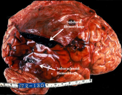 1) Subdural hemorrhage - most commonly caused by damage to bridging veins beneath the dura mater 

2) Tearing leads to slow blood loss and venous blood accumulates slowly; herniation takes much longer to occur 

3 ) Occurs more often in elderly vs. yo