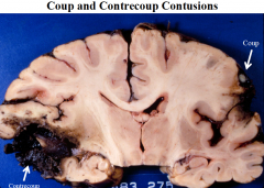 1) Coup Contusion - bruising of tissue immediately beneath the point of injury

2) Contrecoup Contusion -  bruising of tissue that is immediately opposite that affected by the coup contusion; this results from the hitting of the brain into the opposite 