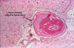 In patients with hypertension, small arterioles can also become thickened produce in the characteristic onion skinned histological appearance. 

1) What can this potentially lead to?

2) Where is this most common?