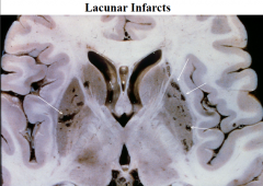 1) This can lead to LACUNAR INFARCTS  

2) most common places in basal ganglia and pons
