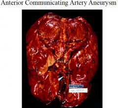 1) Berry aneurysms at proximal bifurcations of cerebral blood vessels = most common cerebral aneurysms 

2) a) anterior circulation 
b) 10% in posterior circulation