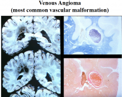 1) FALSE 
venous angiomas are clinically silent and require no therapy

2) venous angiomas are the most common vascular formations