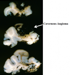 1) What are cavernous angiomas? 

2) What can these cause?