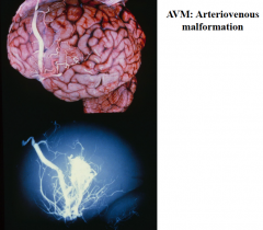 1) Arteriovenous Malformations (AVM) - most common vascular malformation requiring clinical intervention 

2) Most commonly present after intracerebral hemorrhage 

3) Vessels show arteriolization of the veins because of arterial blood pressure commun