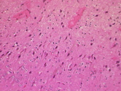 Hippocampal atrophy on the left
FLAIR hyperintensity

Both indicate hippocampal sclerosis

Close-up of CA1 region is shown above and shows neuronal loss