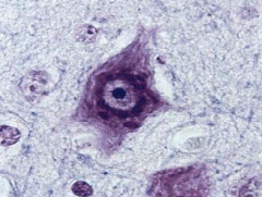 Cortical dysplasia - gray matter in an abnormal area

Balloon cell shown above can be seen in the region of dysplasia