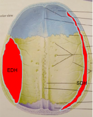 Epi - between dura and skull, sub - between dura and arachnoid
Epi - lens shape, sub - crescent towards periphery
Epi - respects the suture lines, sub - does not respect suture lines