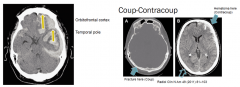 Contusion (left) - bruising of the brain from impact
Coup-contrecoup [it's an e, not an a] (right) - Coup injury at the site of impact, contrecoup injury at the opposite end of the head (front back, left right)