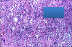 What disease process is present here? What cells are present?
