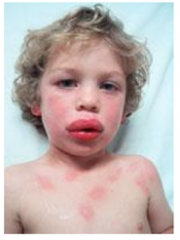 Part of the systemic food allergy reaction

Angioedema: localized swelling of deeper layers of skin and subcutaneous tissue (on this boy's lips)
Urticaria: hives (on this boy's chest)