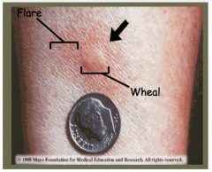 Wheal and Flare reaction: can appear within 5-10 minutes after administration of antigen and usually subsides in less than an hour. Due to local release of histamine