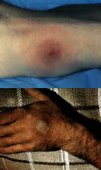 These images are WHAT STAGE of WHAT DISEASE?