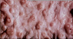 What disease is depicted here?