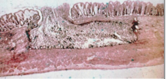 This histological slide is indicative of what disease?