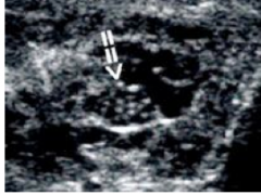 What disease is shown in this ultrasound? How do you diagnose this disease?