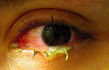 Viral Conjunctivitis (Pink Eye)