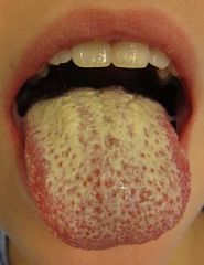 Vulvovaginal Candidiasis

Thrush (oral cavity)