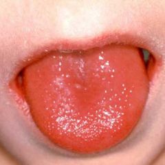 В следващите дни температурата се нормализира, езикът се очиства от налепа и се развива т.н. "малинов език". Силно зачервен, с изпъкнали вкусови папили. Ангината преминава, но може да има поява на фоликуларни, лакунарни или по-обширни налепи по тонзилите.