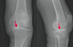 What type of arthritis has this appearance?