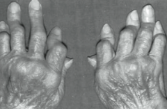Rheumatoid Arthritis
- Note boutonnière deformities of PIP joints with ulnar deviation