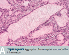 Tophus (deposit of crystalline uric acid and other substances at the surface of joints or in skin or cartilage)
- Often on external ear, olecranon bursa, or Achilles tendon