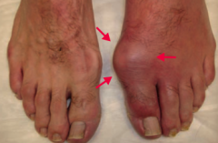 - Asymmetric joint distribution (typically a monoarthritis)
- Joint is swollen, red, and painful
- Classically in the MTP joint of the big toe (podagra)
- Tophus formation 
- Acute attacks tend to occur after a large meal or alcohol consumption