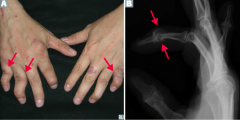 - Joint pain and stiffness
- Asymmetric and patchy involvement
- Dactylitis ("sausage fingers")
- "Pencil-in-cup" deformity on x-ray