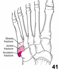 *Jones Fracture (Base of the 5th MT)


 


*Stress Fracture (Distal to jones)


 


*Avulsion Fracture (Peroneal brevis avulses off styloid process)