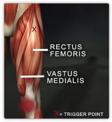 Large muscle located above quadriceps tendon and patella