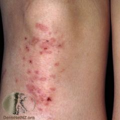 Due to intolerance to the gliadin fraction of gluten  (90% also have enteropathy).



Symmetrically distributed extremely itchy papules and vesicles on normal or reddened skin, which often appear in groups. Blisters are often eroded and crusted du...