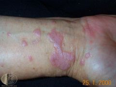 autoimmune disease in which inflammatory cells attack an unknown protein within skin and mucosal keratinocytes

shiny, flat topped firm papules most often found on wrist, lower back and ankles. Can also be found in oral cavity, vulva and penis.