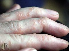 What am I? A form of eczema affected hands and fingers characterised by vesicles