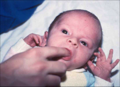 2-5 months
Position: supine with head in midline     Stimulus: place finger or nippleinto infant’s mouth
Response: rhythmical suckingmovements