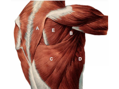 dx=med scapular winging, 2^ long thoracic nerve palsy & serratus anterior deficiency, shown w/ the letter D, A - Trapezius;  B - Teres maj; C - Latissimus; E - Infraspinatus.Ans4